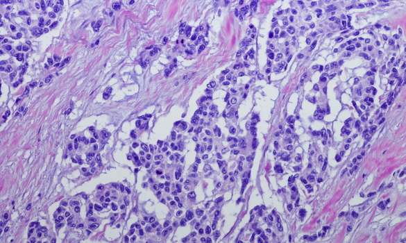 ​Providing Holistic Care for Advanced and Rare Tumours | National Cancer Centre Singapore