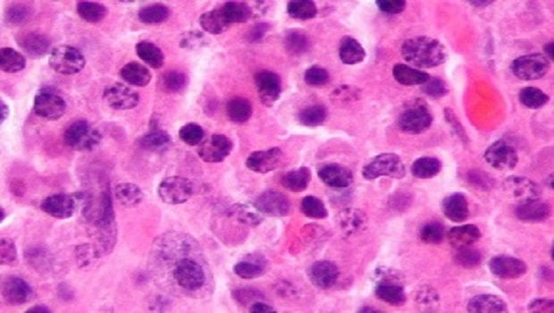 Efficacy of new treatment for high-risk myeloma patients