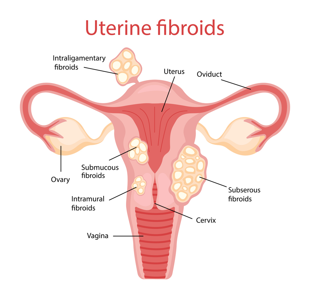 uterus with uterine fibroids | SingHealth