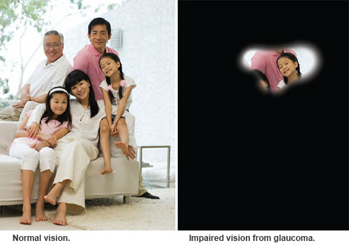 Glaucoma vision versus normal vision - Singapore National Eye Centre
