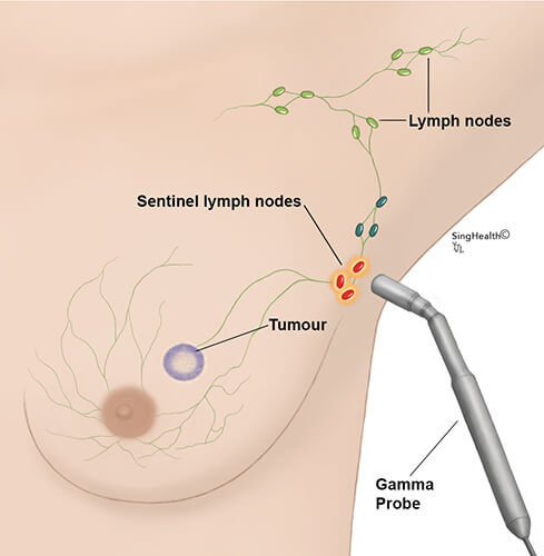 Sentinel Lymph Nodes Biopsy
