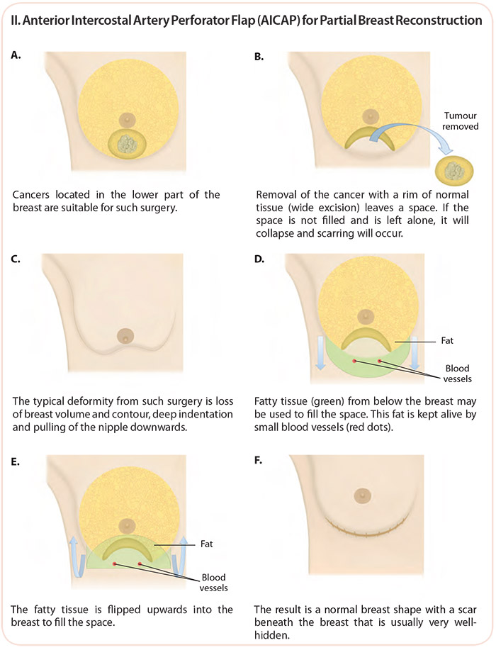 Anterior Intercostal Artery Perforator Flap (AICAP) for Partial Breast Reconstruction