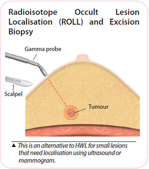 Breast cancer diagnosis - Radioisotope occult lesion localisation and Excision biopsy