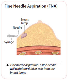 Breast cancer diagnosis - Fine Needle Aspiration (FNA)