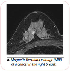 Breast Cancer Diagnosis - Magnetic Resonance lmaging MRI