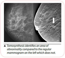 Breast Cancer Diagnosis - Tomosynthesis