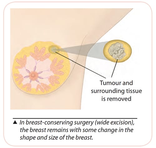 Wide Excision Breast-Conserving Surgery SingHealth-Duke NUS Breast Centre