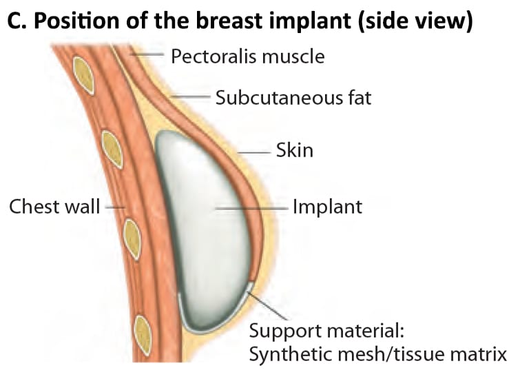 Breast Reconstruction Involving Tissue Expander And Implant