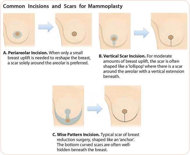 Common Incisions and Scars for Mammoplasty