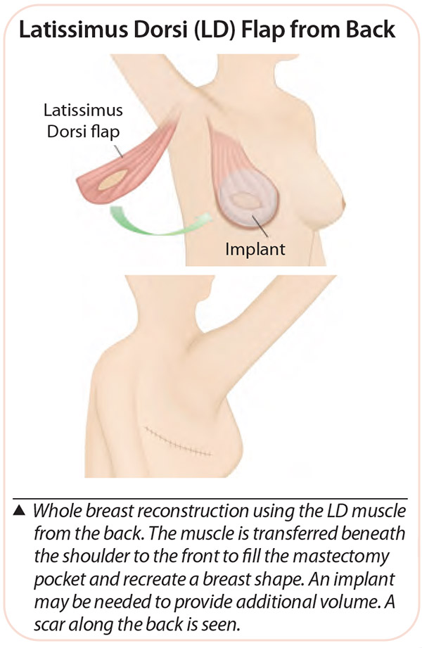 Latissimus Dorsi (LD) Flap from Back - Flap reconstructions Breast Surgery