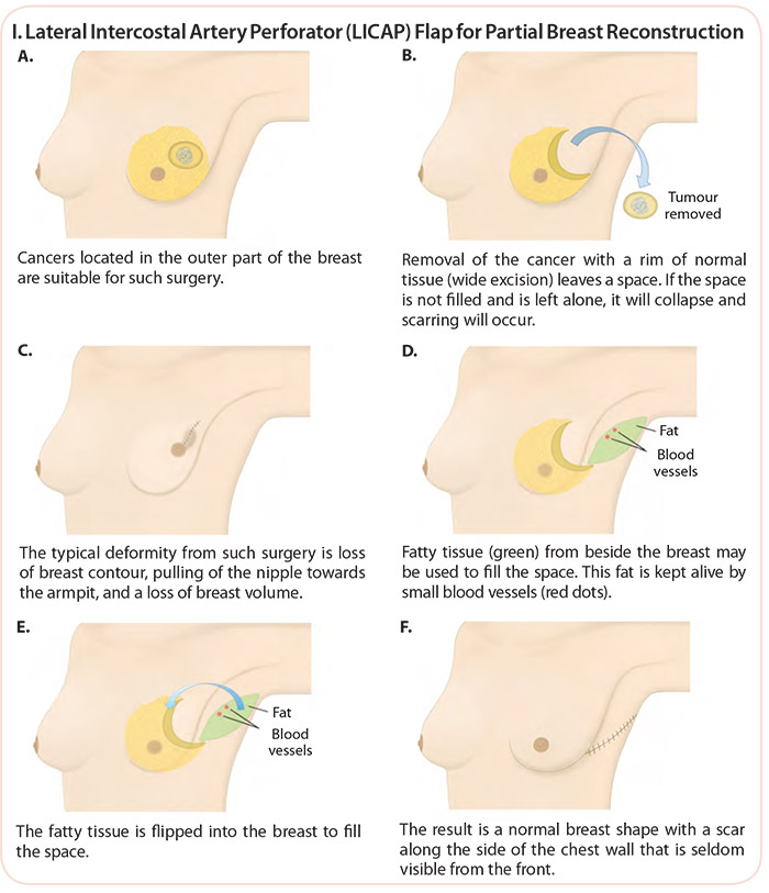Partial Breast Reconstruction – Volume replacement with a local perforator flap