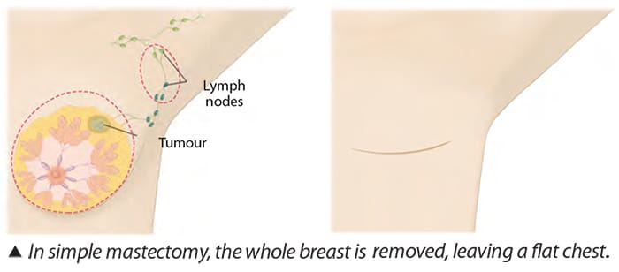 In simple mastectomy, the whole breast is removed, leaving a flat chest. - SingHealth-Duke NUS Breast Centre Breast Surgery