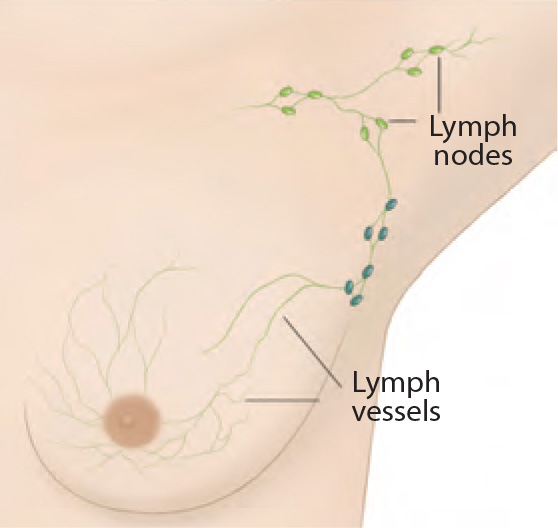 Sentinel lymph node biopsy is used to examine the lymph nodes for cancer.