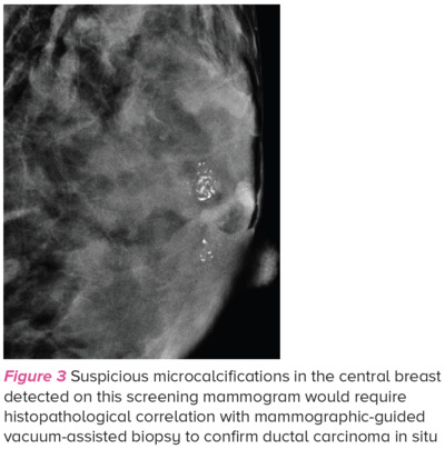 Suspicious microcalcifications - SingHealth Duke-NUS Breast Centre