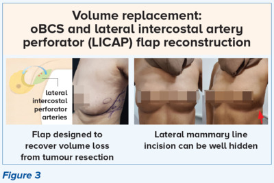 oBCS and LICAP Flap Reconstruction Volume Displacement and Volume Reduction oBCS Techniques - SingHealth Duke-NUS Breast Centre