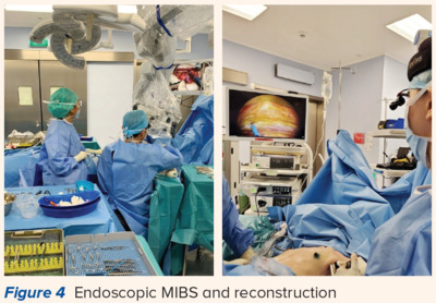 Endoscopic MIBS and Reconstruction Volume Displacement and Volume Reduction oBCS Techniques - SingHealth Duke-NUS Breast Centre