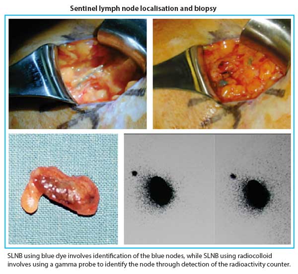 Treatment for breast cancer - sentinel lymph node localisation and biopsy.