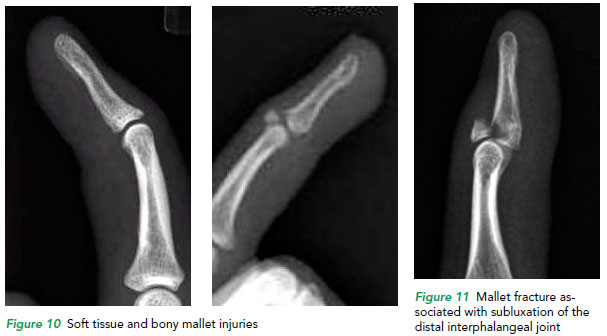 Soft tissue and bony mallet injuries - SGH.