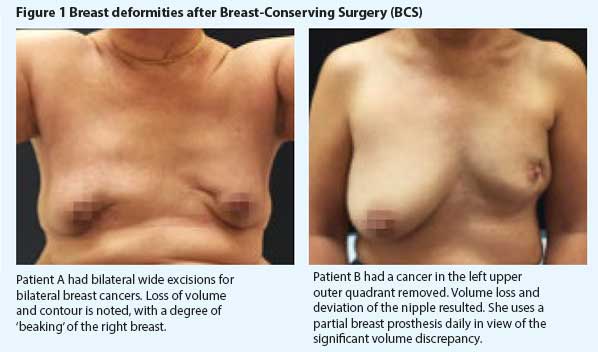 Oncoplastic breast surgery - breast deformities after breast-conserving surgery - SingHealth Duke-NUS Breast Centre.