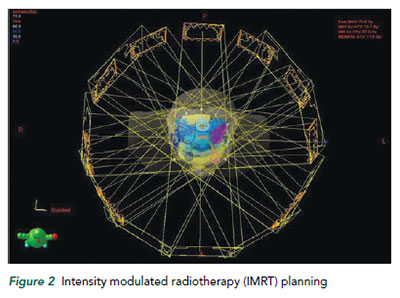 Intensity modulated radiotherapy (IMRT) planning - - National Cancer Centre Singapore
