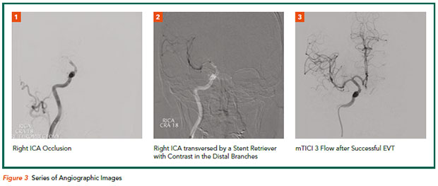 Hyper-acute stroke treatment - angiographic images  - National Heart Centre Singapore