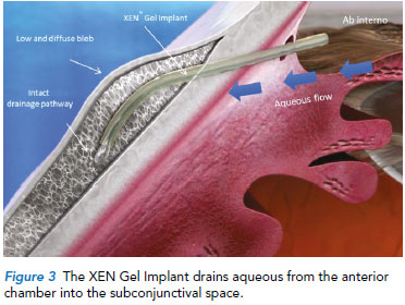 XEN Gel implant - Singapore National Eye Centre