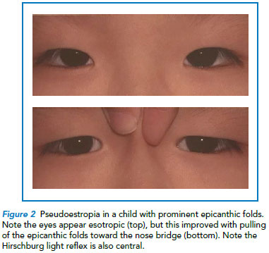 Patient with pseudoestropia - Singapore National Eye Centre