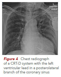 Chest radiograph of a CRT-D system - National Heart Centre Singapore
