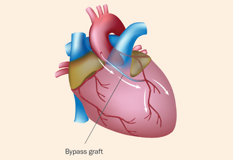 Coronary Artery Bypass Grafting - To Do It Or Not?