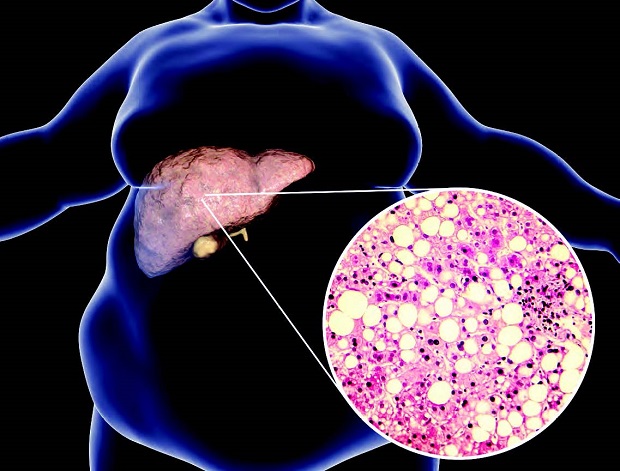Zooming in on liver fat