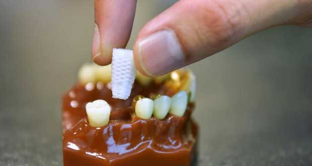  ​​Researchers at the National Dental Centre Singapore have developed an enhanced bioresorbable 3D-printed dental plug which promotes bone growth in the jaw, reducing the chances of bone shrinkage after an extraction.ST PHOTO NG SOR LUAN
