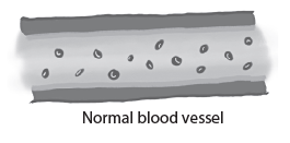 Brain aneurysm normal blood vessel