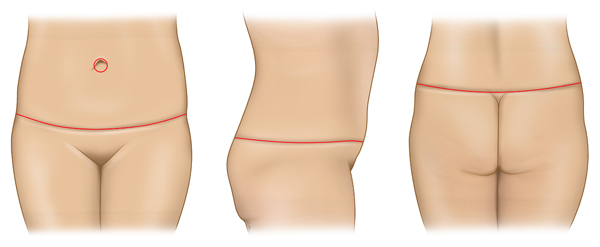 Tummy-Tuck (Abdominoplasty) and Lower Body Lift