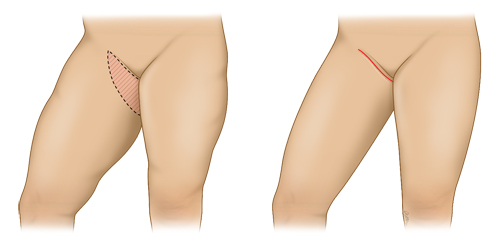 https://www.singhealth.com.sg/sites/shcommonassets/Assets/conditions-treatments/SGH/thigh%20lift/thigh2%20500.jpg