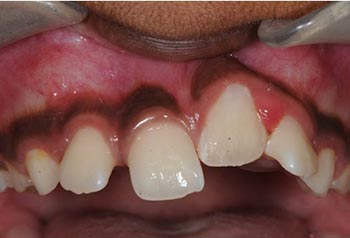 ankylosis of tooth