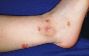 Insect Bites and Papular Urticaria