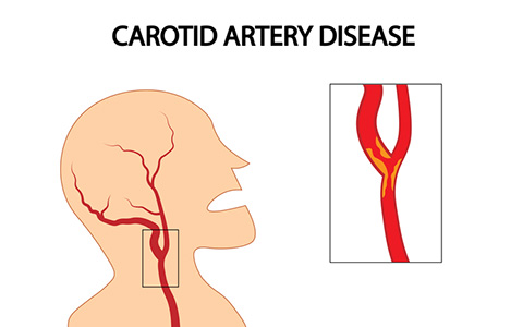Neurovascular Carotid artery disease condition and treatments