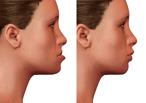 Orthognathic surgery condition and treatments
