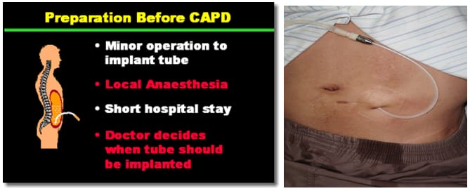 Preparation before CAPD - Dialysis condition and treatment