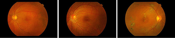 central serous chorioretinopathy conditions & treatments