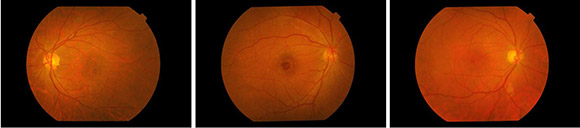 macular hole conditions & treatments