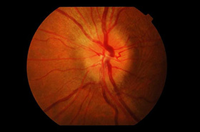 optic neuritis condition treatment - swollen left optic disc