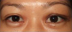 Orbital Tumours Left Eye Protrusion