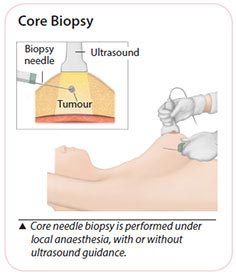 breast cancer core needle biopsy