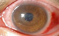 Corneal Infection due to parasite Microsporidia - Eye Condition and Treatments SingHealth