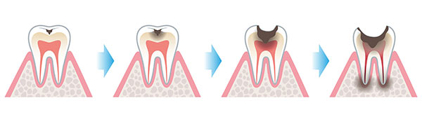 cavity formation in early childhood caries
