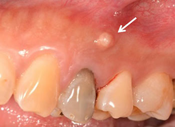 gum boil or sinus tract