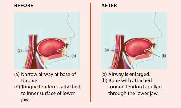Difference in airways after Genioglossus Advancement Surgery, National Dental Centre Singapore