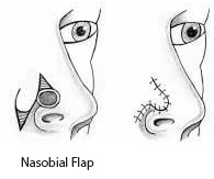 Nasolabial flap - Head and Neck Centre