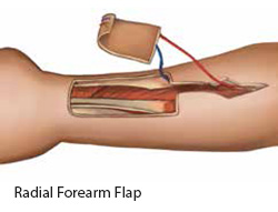 Radial Forearm Flap - SingHealth Duke-NUS Head and Neck Centre